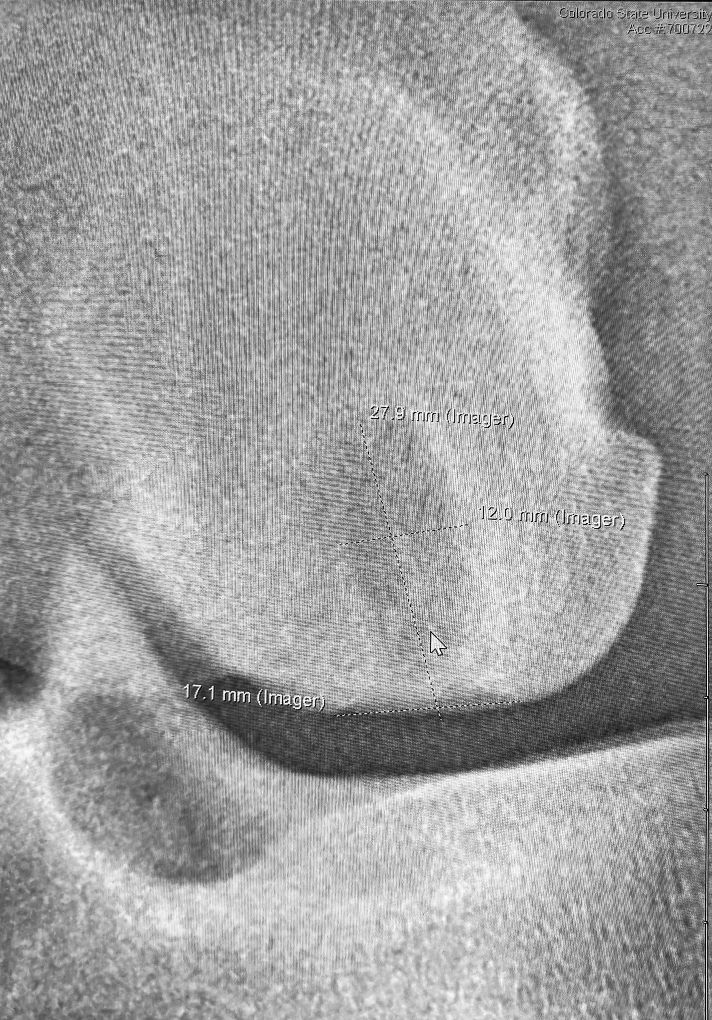 CSU radiographic/arthroscopic still with on-screen lesion measurements